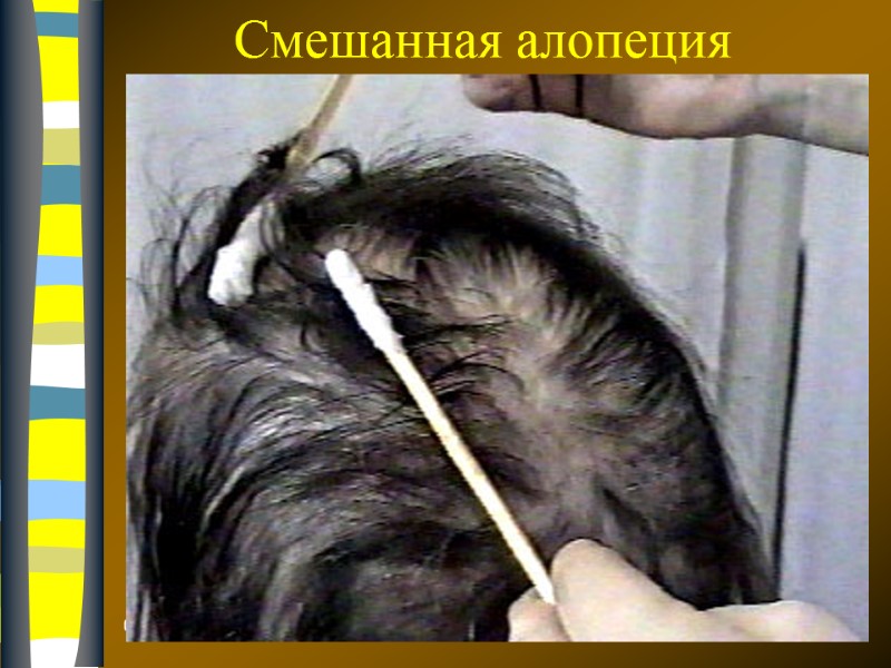 09.12.2017 Смешанная алопеция